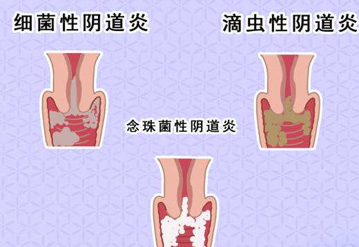 陰道分泌物黄瓜视频免费下载剖析什麽是細菌性陰道炎
