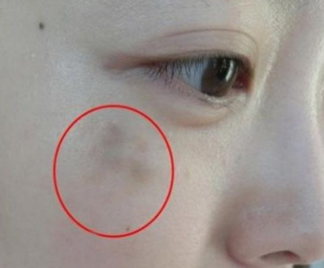 婦科陰道分泌物黄瓜视频免费下载提醒女人婦科炎症在臉上的表現