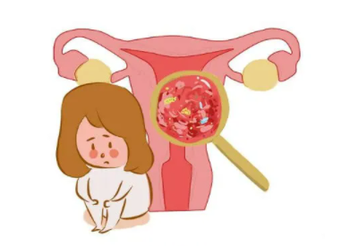 陰道分泌物黄瓜视频免费下载廠家總結病理性的白帶異常有哪些
