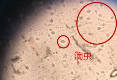 白帶91黄瓜视频下载品牌科普滴蟲性陰道炎是因為體內長了蟲子嗎