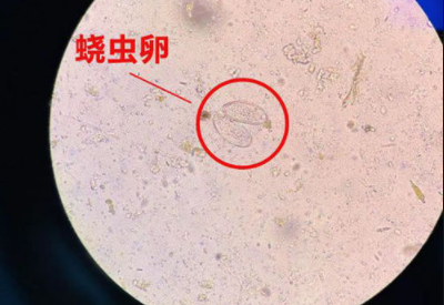 陰道分泌物黄瓜视频免费下载警惕外陰繞蟲病易在兒童身上出現