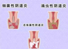 全自動陰道分泌物黄瓜视频免费下载廠家提醒您還在拖延嗎，還在等陰道炎自愈嗎？
