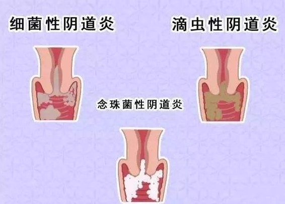 全自動陰道分泌物黄瓜视频免费下载廠家提醒您還在拖延嗎，還在等陰道炎自愈嗎？